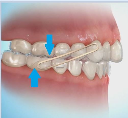 How Do Clear Aligners Straighten Teeth?