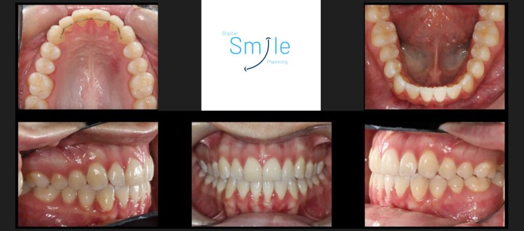 Digital Smile Planning - Setups