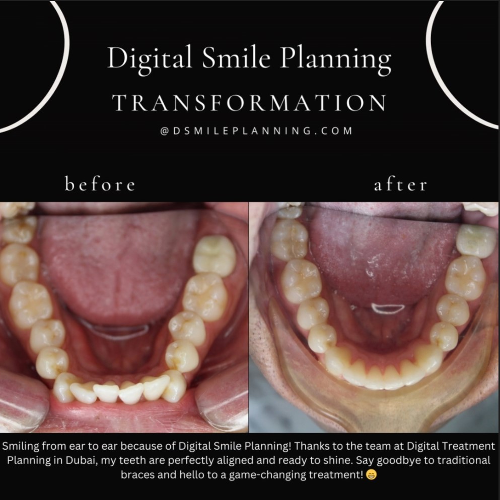 Digital Smile Planning Before And After Results