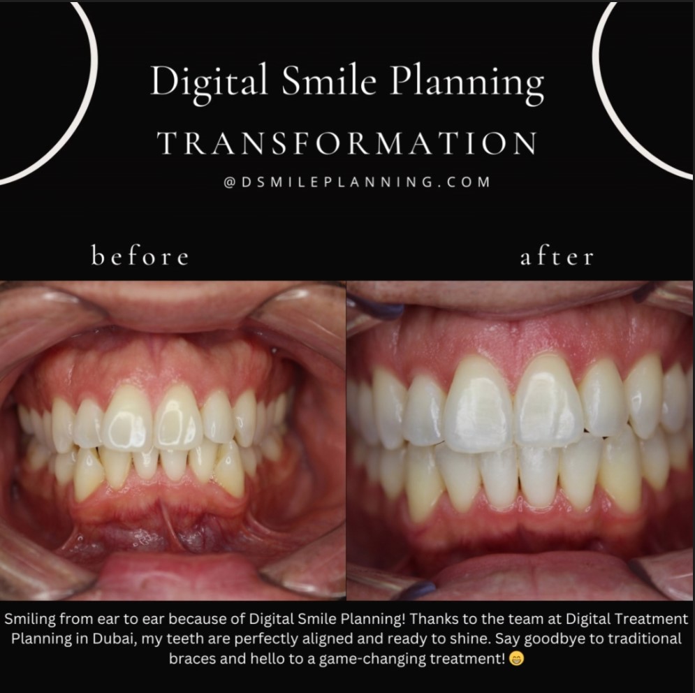 Digital Smile Planning Before And After Results