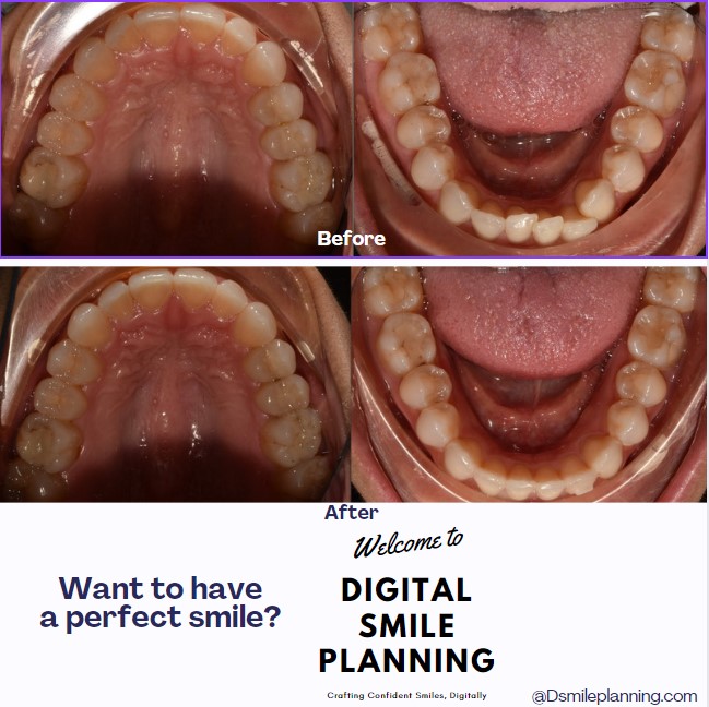 Digital Smile Planning Before And After Results