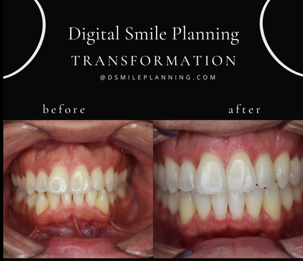 Digital Smile Planning Before And After Results