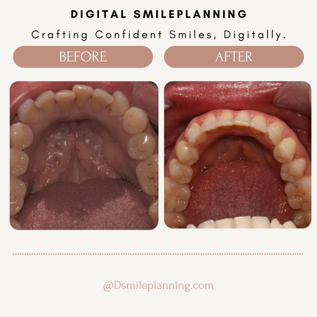 Digital Smile Planning Clear aligners