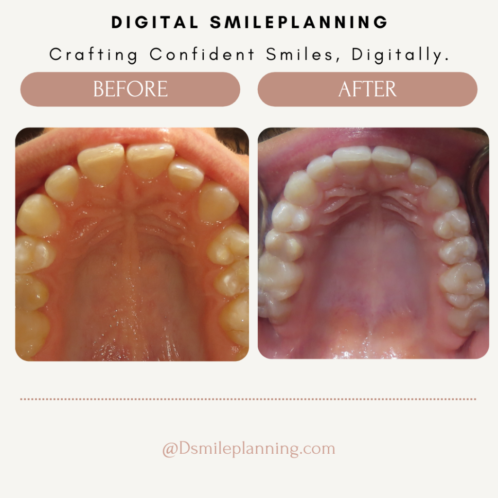 Digital Smile Planning 