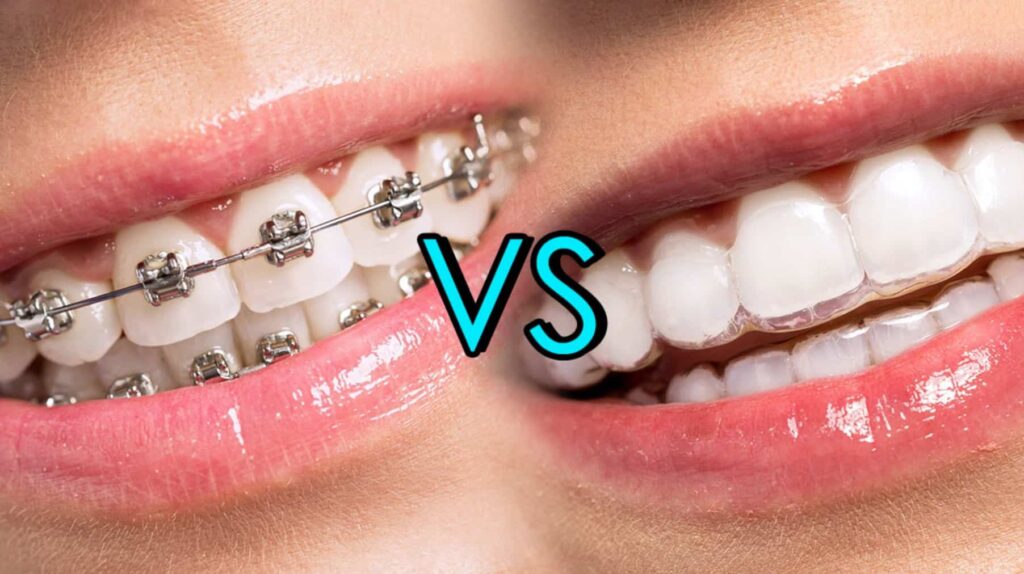 Clear Aligners Are A Strong Alternative To Braces